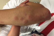 Allergic Reactions to Bedbug Bites: What to Do