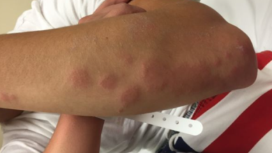 Allergic Reactions to Bedbug Bites: What to Do