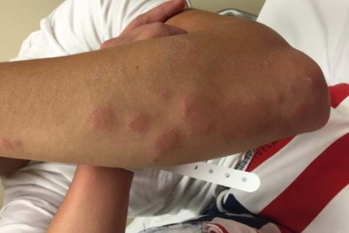 Allergic Reactions to Bedbug Bites: What to Do